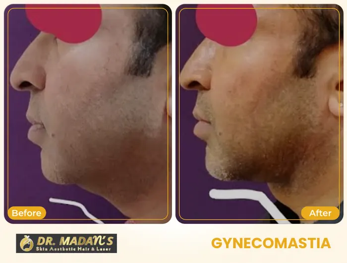 Double chin before and after result 3 at Dr Madan Aesthetics